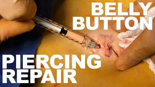 Belly Button Repair - Dr Paul Ruff  West End Plast