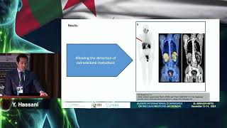 AICONM24 - The Tc99m-PSMA SPECT/CT : future and diagnosis performances (Y.HASSANI)