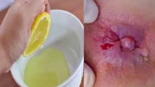 How To Get Rid Of Postpartum Hemorrhoids Fast - Natural health cures
