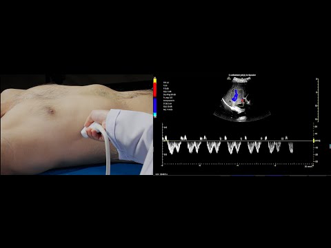 VExUS Made Easy: 4 Simple Steps to Assess Venous Congestion