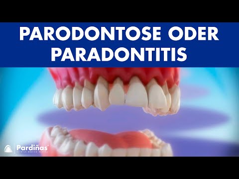 Parodontose oder Paradontitis ©