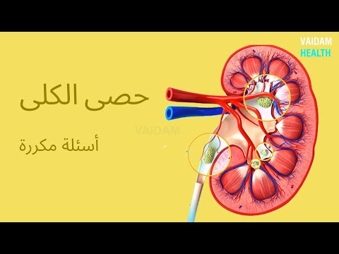الأسئلة المتداولة حول حصوات الكلى