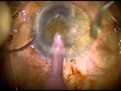Mature Cataract, Very Poor View