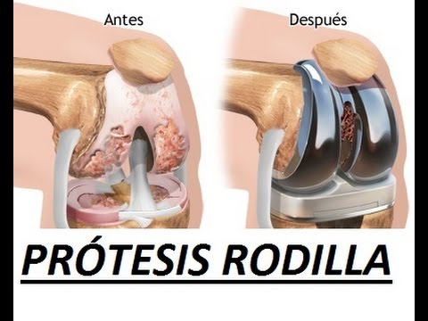 Bloqueo de dolor en la articulación del hombro Dolor en la rodilla conjunta deporte