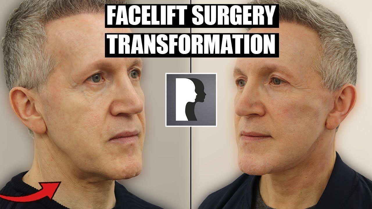 AMAZING MALE FACELIFT TRANSFORMATION IN ONLY 2 MONTHS! – NATURAL RESULTS