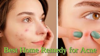 Best Home Remedy for Acne Treatment | How to get rid of acne