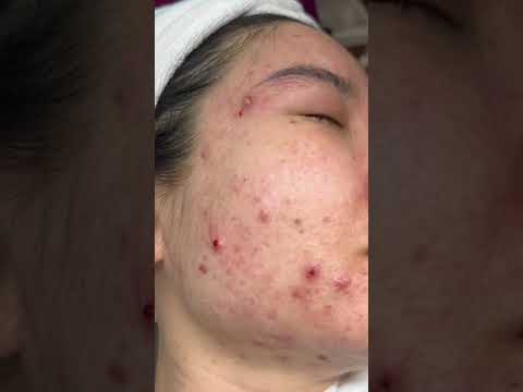 Skin Care Treatment at DIVA Skin Clinic Poipet