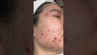 Skin Care Treatment