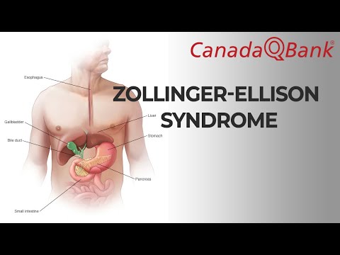 Zollinger-Ellison syndrome
