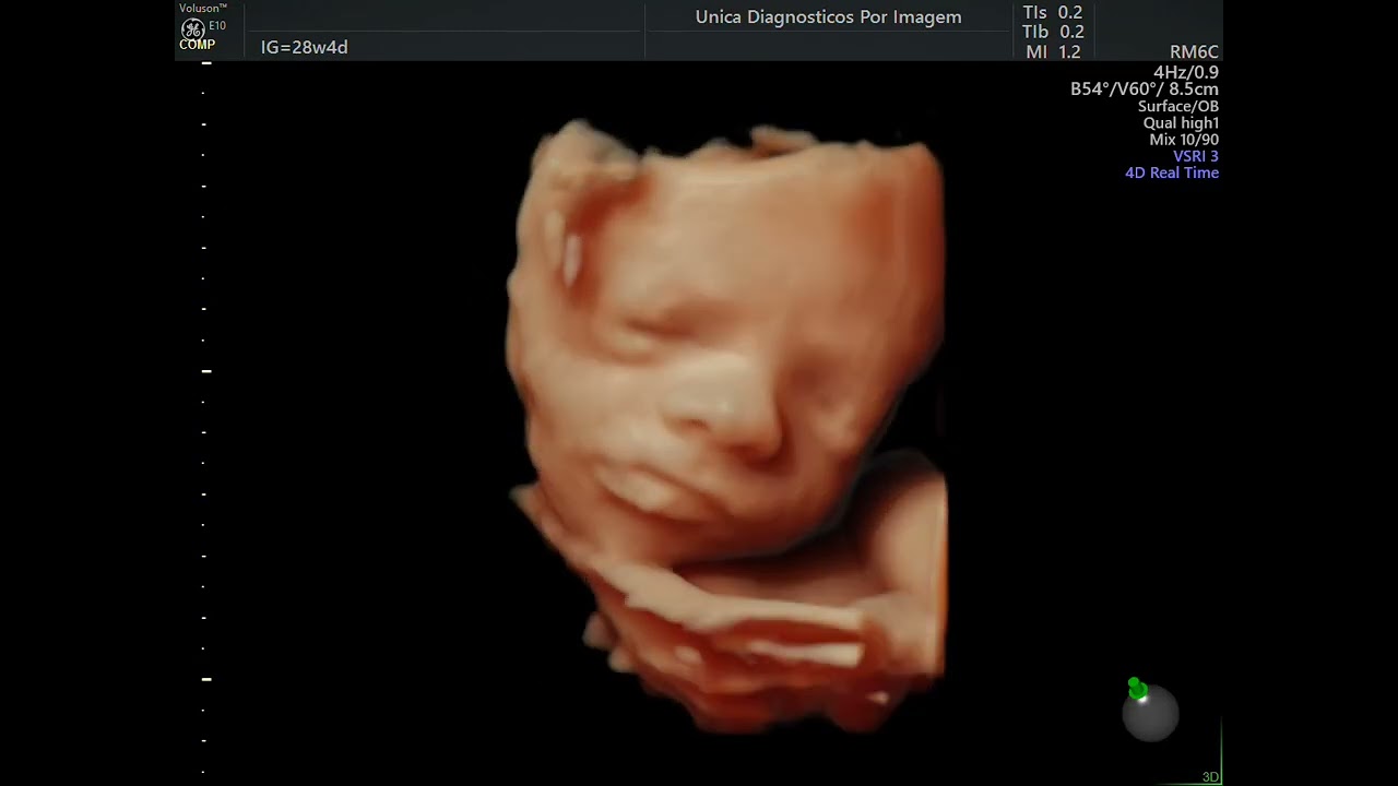Ultrassom 3D-4D - 1