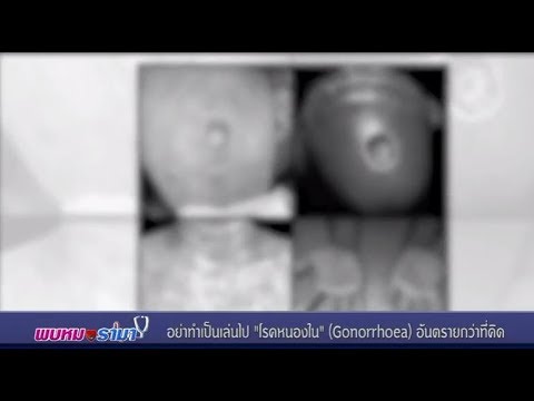 โรคสะเก็ดเงินบนฝ่ามือ การแพทย์แผนจีนรีวิวกลาก