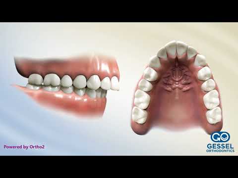 Upper 2nd Bicuspid Extraction