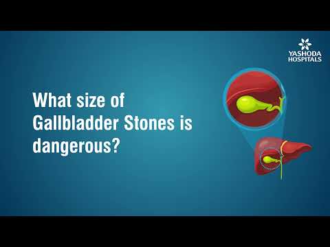 What size of Gallbladder Stone is dangerous?
