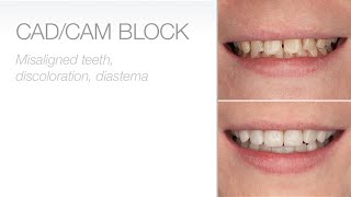 edelweiss CAD/CAM Blocks