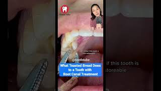 Cracked tooth 🫣#cavity #rootcanal #dentist #dentistry #dentalvideo #teethwhitening