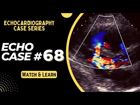 Echocardiography Case 68: Echo Spot Diagnosis Series | Echo Interpretation Made Easy