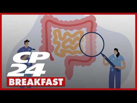 Ontario lowering age for colorectal screening