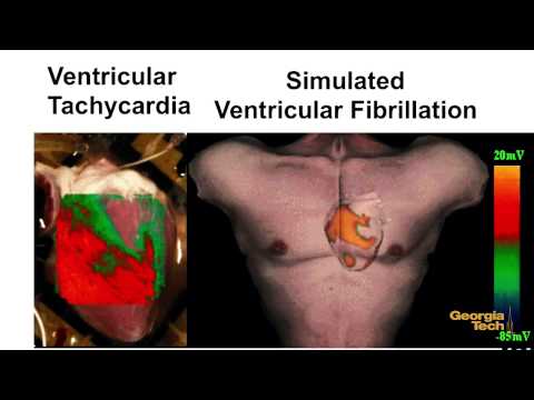 Georgia Tech Studies Spiral Waves for Heart Research