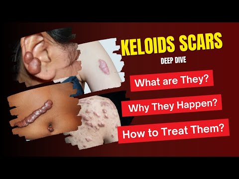 Keloids Scars Deep Dive | What are They? |  Why They Happen? | How to Treat Them?