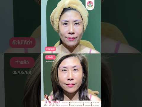 ปรับรูปหน้าแบบองค์รวมโดยใช้โปรแกรม Filler เพียง 6 cc