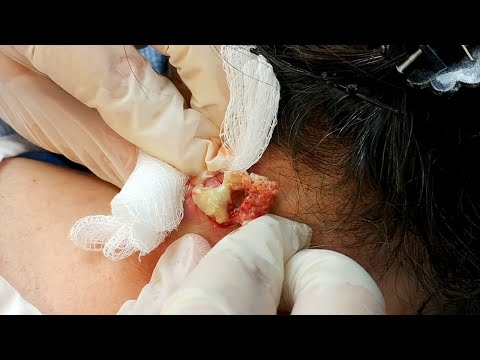 CYST Popping! So much stuff coming out