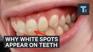 Here's why some people have white spots on their teeth