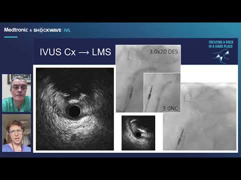 Challenges of Calcified Bifurcations: Treating a Rock in a Hard Place