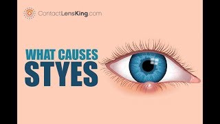 What Are Styes? Causes, Symptoms and Treatments