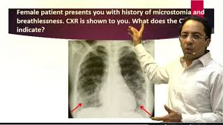 Download Lagu Scleroderma CXR : eQ-Exclusive MCQ Discussion Series on eMedicoz Thumbnail