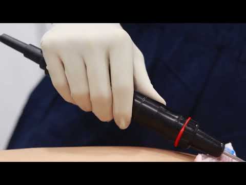 MARCACION ABDOMINAL
