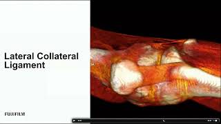 Ultrasound Evaluation of the Medial and Lateral Knee 