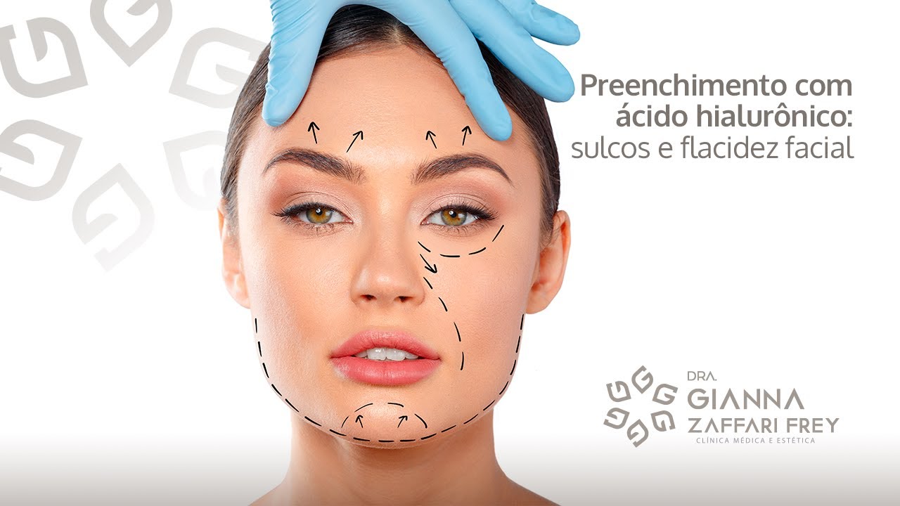 Watch Now Preenchimento com ácido hialurônico: sulcos e flacidez facial | Dra. Gianna Zaffari Frey Preenchimento com ácido hialurônico: sulcos e flacidez facial | Dra. Gianna Zaffari Frey