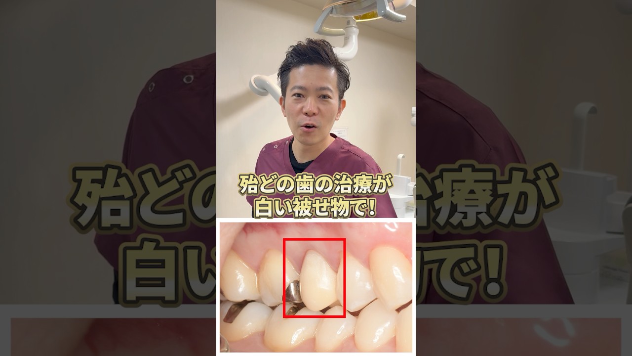保険で白い歯❗️実は、全ての歯を白くできます！#保険#白い歯#セラミック