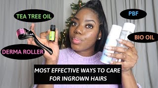 HOW  TO TREAT & GET RID OF  PAINFUL  INGROWN HAIRS IN THREE DAYS! -NEW TIPS