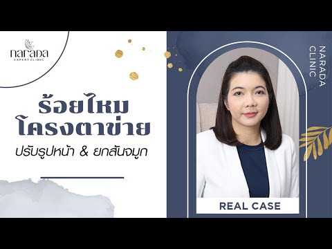 ร้อยไหม หน้าเรียว
