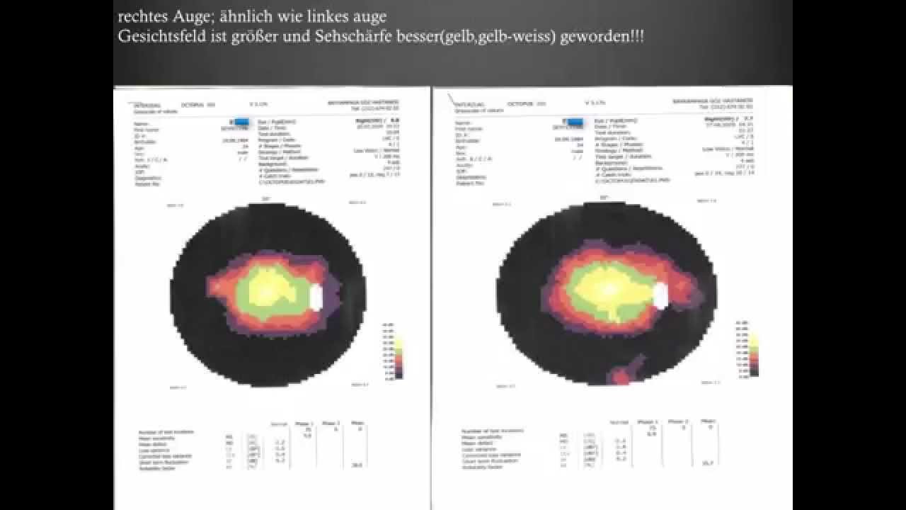 Beweis der Behandlung- Retinitis Pigmentosa- Gesichtsfeldtests 4 FIRATLI CLINIC