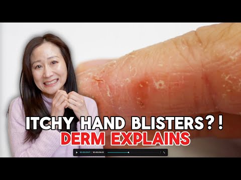 Tiny Itchy Blisters on Your Hands? Here’s What You Need to Know! | Dr. Jenny Liu