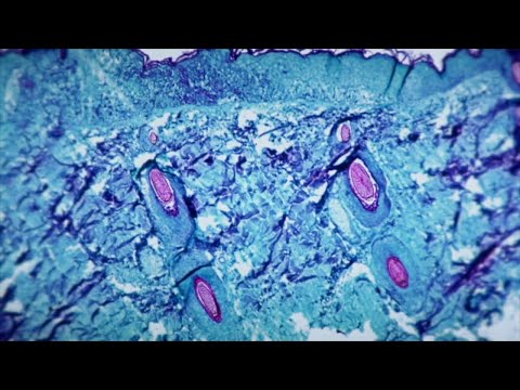 NY Long Island Suffolk County Fire Island Monkeypox Latest