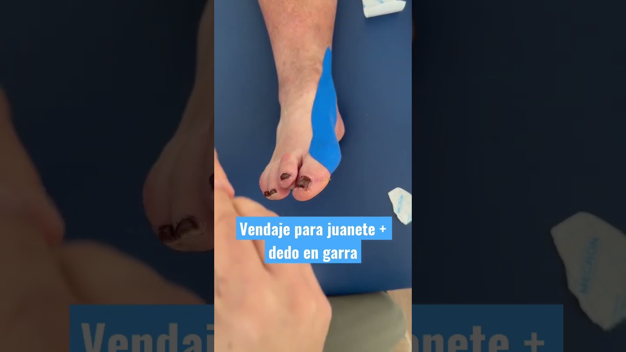 Vendaje Neuromuscular para Hallux valgus + dedo en garra. #kinesiotape