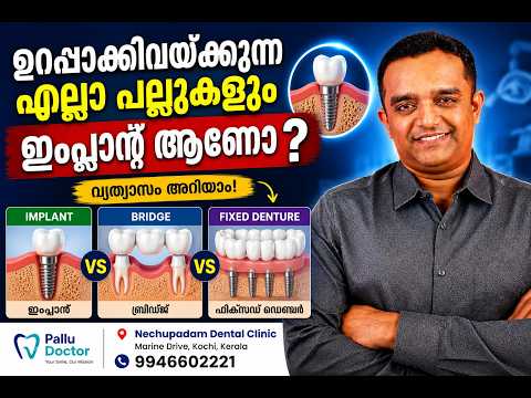 Implant, Bridge, Denture – ഏതാണ് നിങ്ങള്‍ക്കു വേണ്ടത്? Are All Fixed Teeth Dental Implants?