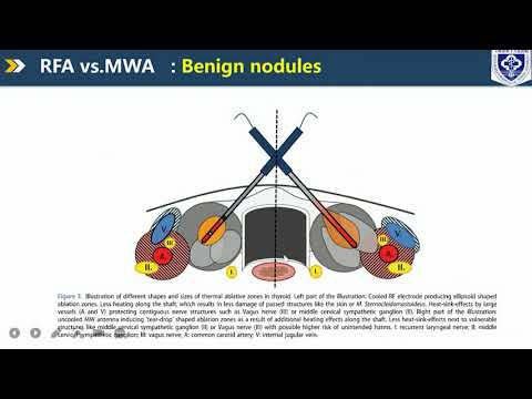 Prof.Hui-xiong Xu: Value and Consideration of Microwave Ablation in the Treatment of Thyroid Nodules