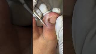 Ep_8690 Ingrown toenail removal 👣 มันมีขี้ดินติดอยู่..หนูจึงตัดเข้าไปค่ะ 😅 (clip from Thailand)