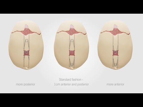CranioXpand | Expanding Possibilities