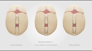 CranioXpand | Expanding Possibilities