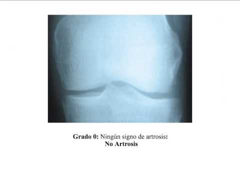 Carte de gitt în tratamentul d artroză