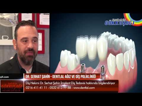 Dt. K. Serhat Şahin İmplant Tedavisi Hakkında Bilgiler