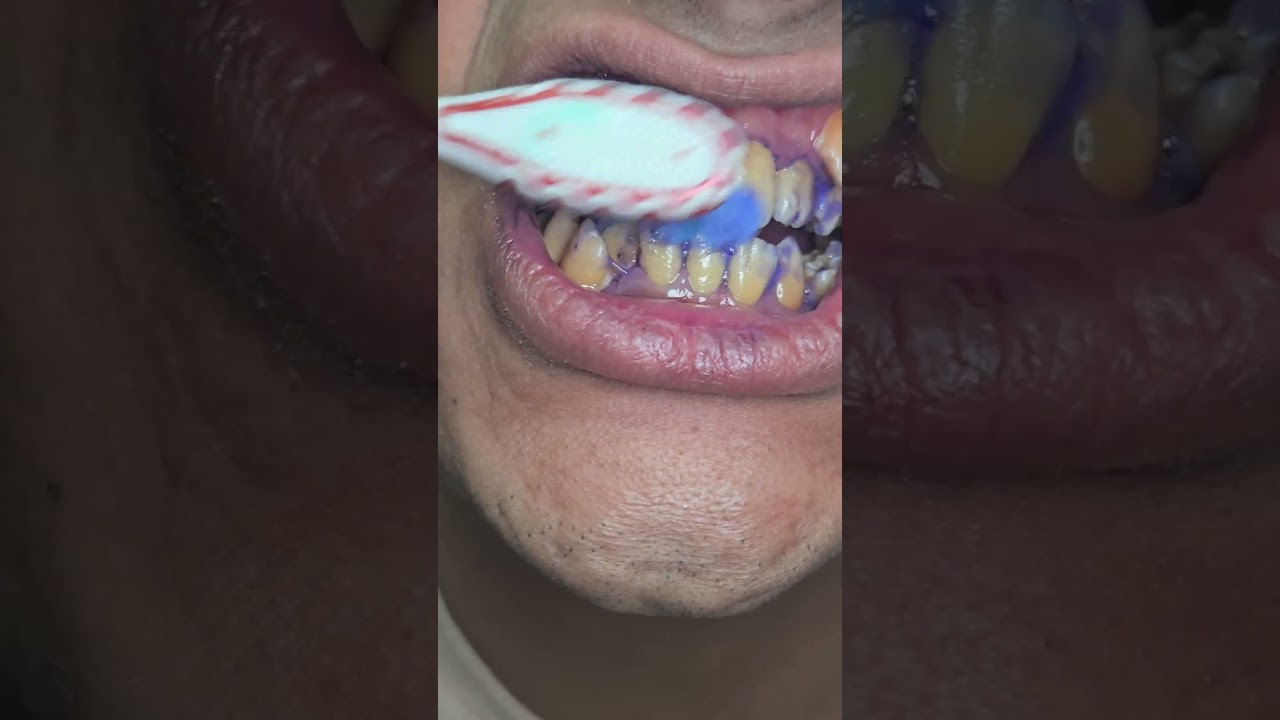 Can This Purple Whitening Toothpaste Whiten My Teeth ? #asmr #dentist #teethdecay #asmrdentist