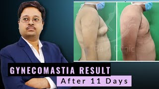 Gynecomastia Result After 11 days By Dr. Jayanta Bain plastic & cosmetic surgeon