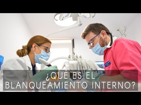 Blanqueamiento dental interno, ¿qué es?