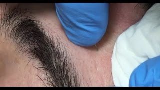 Acne Prevention - Deep Facial Cleansing